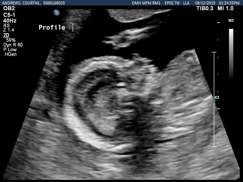 Baby A's Head and Hand