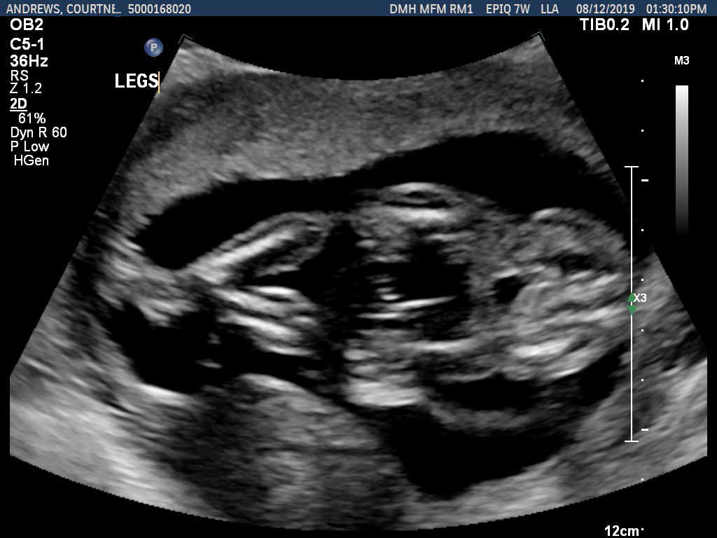Baby A's Legs